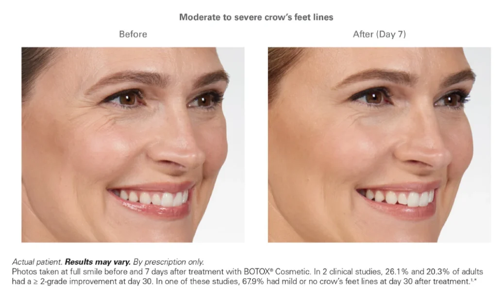 Glo Med Aesthetics | Collage of a woman's face Botox Before & After | Nevada City, CA