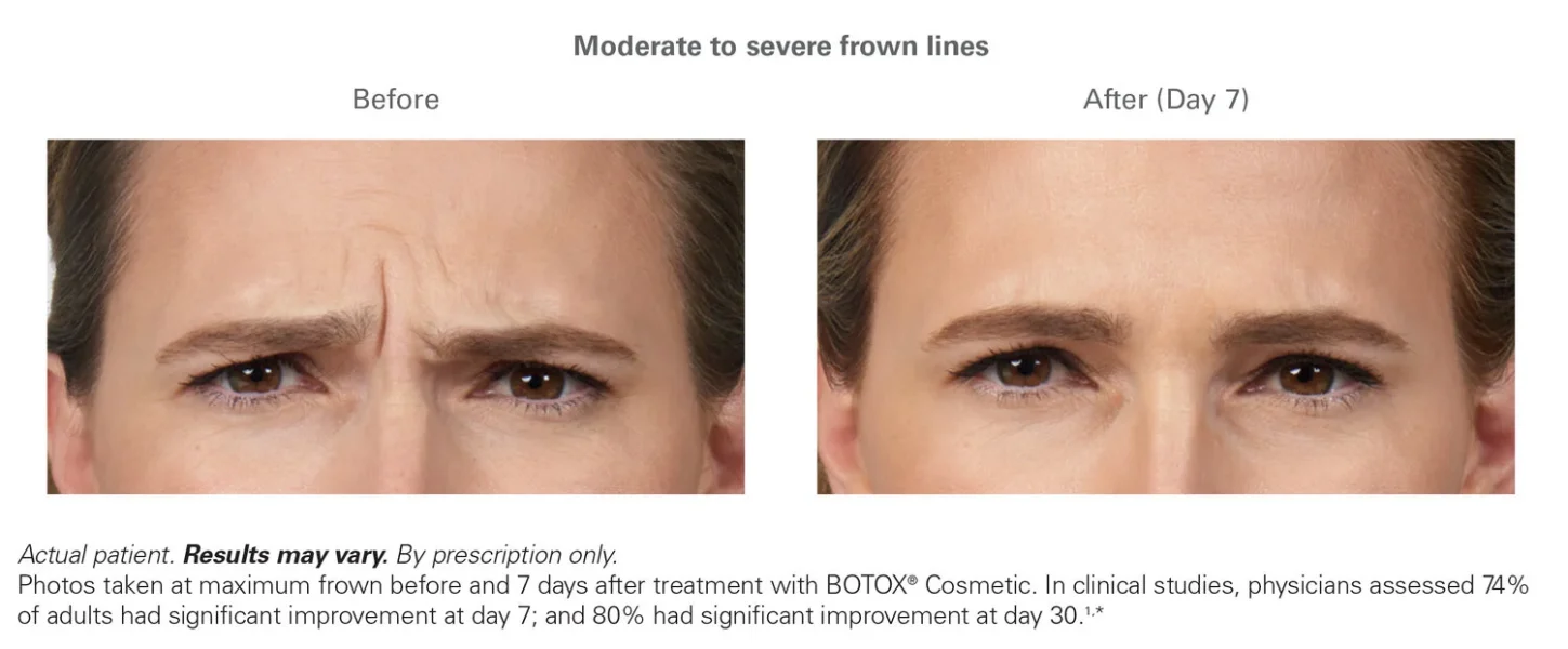 Glo Med Aesthetics Botox Before After Men | Nevada City, CA